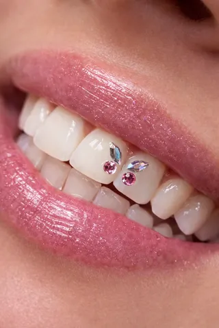 Zubné šperky - kamienky na zuboch