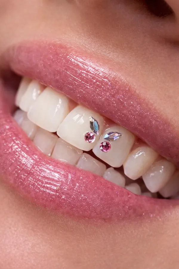 Aplikácia zubného šperku